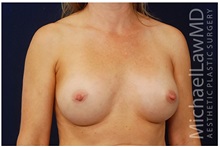 Breast Augmentation After Photo by Michael Law, MD; Raleigh, NC - Case 33497