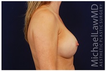Breast Augmentation After Photo by Michael Law, MD; Raleigh, NC - Case 33497