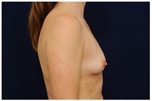 Breast Augmentation Before Photo by Michael Law, MD; Raleigh, NC - Case 33497