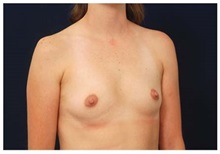 Breast Augmentation Before Photo by Michael Law, MD; Raleigh, NC - Case 33498