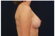Breast Augmentation After Photo by Michael Law, MD; Raleigh, NC - Case 33498