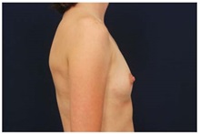 Breast Augmentation Before Photo by Michael Law, MD; Raleigh, NC - Case 33498