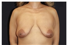 Breast Lift Before Photo by Michael Law, MD; Raleigh, NC - Case 33499