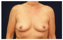 Breast Lift Before Photo by Michael Law, MD; Raleigh, NC - Case 33500