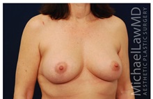 Breast Lift After Photo by Michael Law, MD; Raleigh, NC - Case 33500