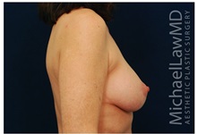 Breast Lift After Photo by Michael Law, MD; Raleigh, NC - Case 33500