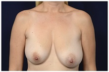 Breast Lift Before Photo by Michael Law, MD; Raleigh, NC - Case 33502