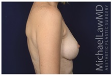 Breast Lift After Photo by Michael Law, MD; Raleigh, NC - Case 33502