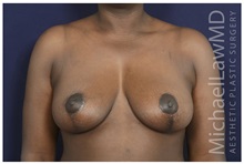 Breast Lift After Photo by Michael Law, MD; Raleigh, NC - Case 33503