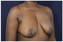 Breast Lift Before Photo by Michael Law, MD; Raleigh, NC - Case 33503