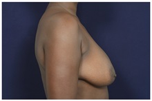 Breast Lift Before Photo by Michael Law, MD; Raleigh, NC - Case 33503