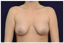 Breast Lift Before Photo by Michael Law, MD; Raleigh, NC - Case 33505