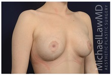 Breast Lift After Photo by Michael Law, MD; Raleigh, NC - Case 33505