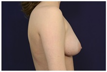 Breast Lift Before Photo by Michael Law, MD; Raleigh, NC - Case 33505