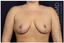 Breast Lift After Photo by Michael Law, MD; Raleigh, NC - Case 33506
