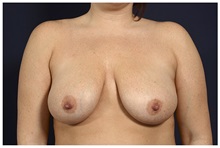 Breast Lift Before Photo by Michael Law, MD; Raleigh, NC - Case 33506