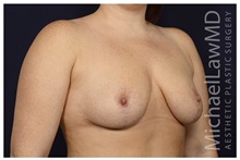 Breast Lift After Photo by Michael Law, MD; Raleigh, NC - Case 33506
