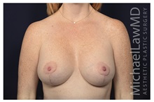 Breast Lift After Photo by Michael Law, MD; Raleigh, NC - Case 33507
