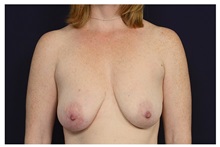 Breast Lift Before Photo by Michael Law, MD; Raleigh, NC - Case 33507
