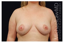 Breast Lift After Photo by Michael Law, MD; Raleigh, NC - Case 33508