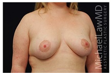 Breast Lift After Photo by Michael Law, MD; Raleigh, NC - Case 33508