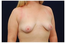 Breast Lift Before Photo by Michael Law, MD; Raleigh, NC - Case 33508