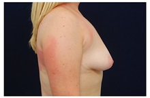 Breast Lift Before Photo by Michael Law, MD; Raleigh, NC - Case 33508