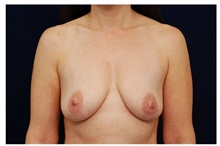 Breast Lift Before Photo by Michael Law, MD; Raleigh, NC - Case 33509