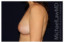 Breast Lift After Photo by Michael Law, MD; Raleigh, NC - Case 33509