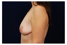 Breast Lift Before Photo by Michael Law, MD; Raleigh, NC - Case 33509