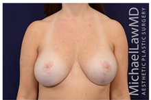 Breast Lift After Photo by Michael Law, MD; Raleigh, NC - Case 33510