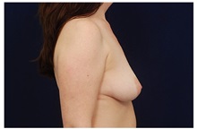 Breast Lift Before Photo by Michael Law, MD; Raleigh, NC - Case 33510