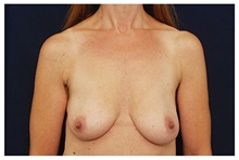 Breast Lift Before Photo by Michael Law, MD; Raleigh, NC - Case 33511