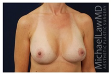 Breast Lift After Photo by Michael Law, MD; Raleigh, NC - Case 33511
