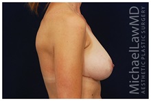 Breast Lift After Photo by Michael Law, MD; Raleigh, NC - Case 33511