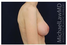 Breast Lift After Photo by Michael Law, MD; Raleigh, NC - Case 33512
