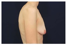 Breast Lift Before Photo by Michael Law, MD; Raleigh, NC - Case 33512