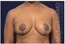 Breast Lift After Photo by Michael Law, MD; Raleigh, NC - Case 33513