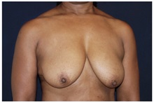 Breast Lift Before Photo by Michael Law, MD; Raleigh, NC - Case 33513