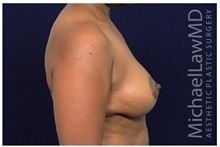 Breast Lift After Photo by Michael Law, MD; Raleigh, NC - Case 33513