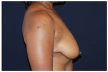 Breast Lift Before Photo by Michael Law, MD; Raleigh, NC - Case 33513