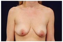 Breast Lift Before Photo by Michael Law, MD; Raleigh, NC - Case 33514