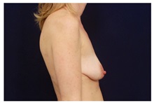 Breast Lift Before Photo by Michael Law, MD; Raleigh, NC - Case 33514