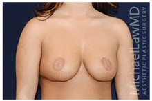 Breast Lift After Photo by Michael Law, MD; Raleigh, NC - Case 33518
