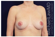 Breast Lift After Photo by Michael Law, MD; Raleigh, NC - Case 33519