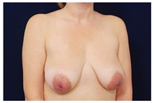 Breast Lift Before Photo by Michael Law, MD; Raleigh, NC - Case 33519