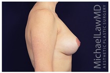 Breast Lift After Photo by Michael Law, MD; Raleigh, NC - Case 33519