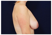 Breast Lift Before Photo by Michael Law, MD; Raleigh, NC - Case 33519