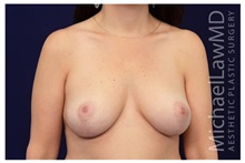 Breast Lift After Photo by Michael Law, MD; Raleigh, NC - Case 33527