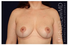 Breast Lift After Photo by Michael Law, MD; Raleigh, NC - Case 33528